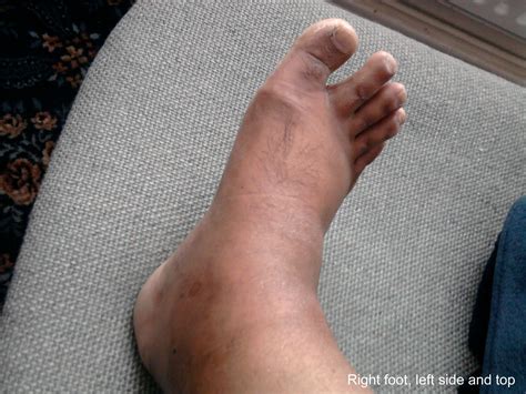 Right foot, left side and top | Gout Sufferer