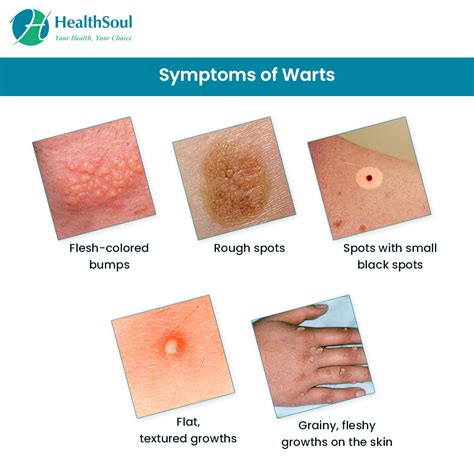 warts