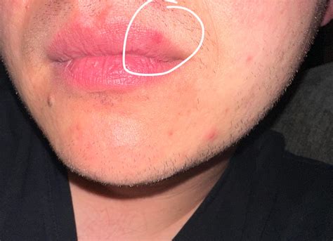 Is my cold sore still contagious? : r/medical