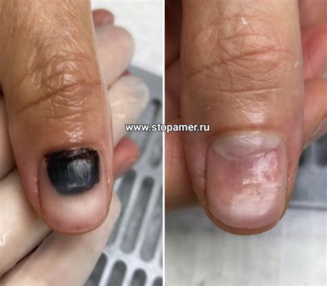 Помощь при термических, химических и физических травмах ногтя — Центре ...