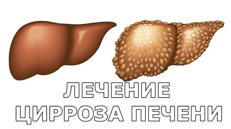Лечение цирроза - YouTube