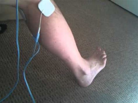 Peroneal Nerve Palsy Treatment A Guide To Understanding Peripheral