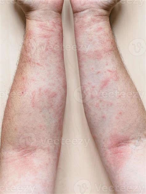 male arms with itchy red rash 11186369 Stock Photo at Vecteezy