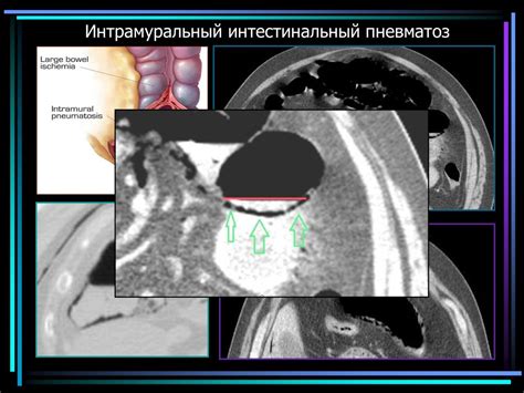 Мезентериальная ишемия