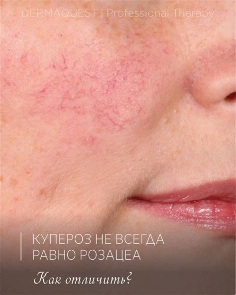 Купероз не всегда равно Розацеа! Розацеа или солнце? Купероз ...