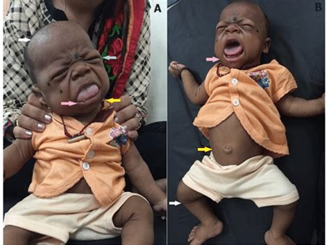 clinical features of congenital hypothyroidism or cretinism: A) white ...