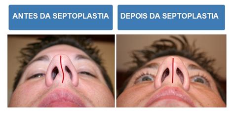 Como É Feito A Cirurgia De Desvio De Septo - Guia sobre desvio de septo | Saúde - TudoPorEmail