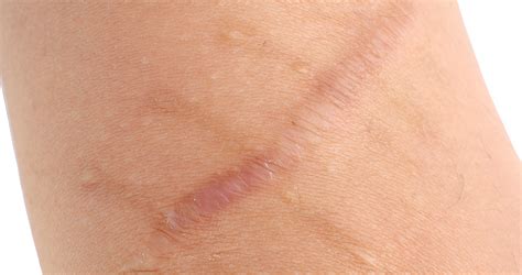 hypertrophic scar      treatment options