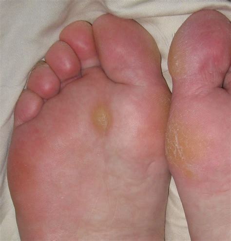 Callus - Wikiwand