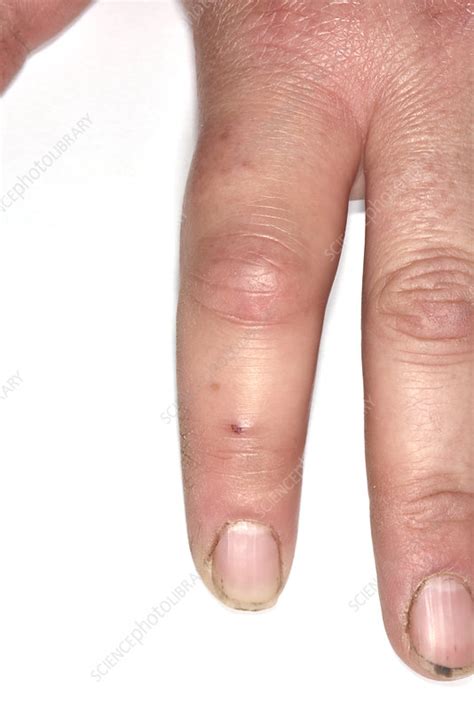 how to tell if a dog bite is infected