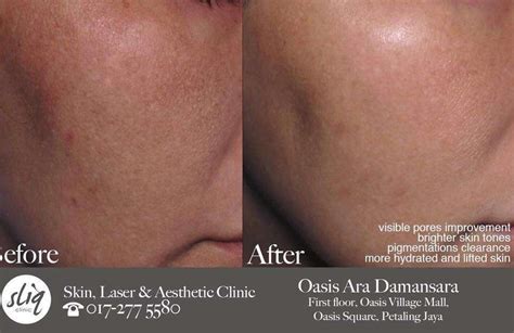 PRP Treatment Kuala Lumpur | Stimulate 100% Natural Growth Factors