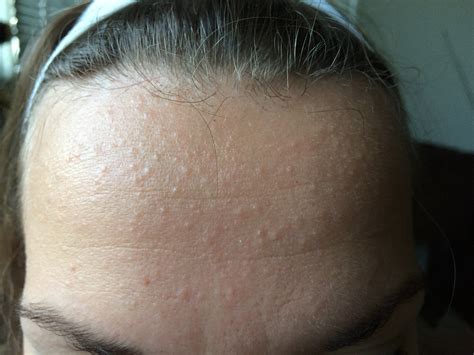 Tiny Red Bumps On Face Rash