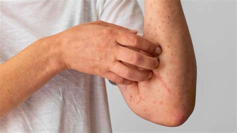 Coceira Apos O Banho - Por que algumas pessoas ficam com coceira após exercício ou banho quente?