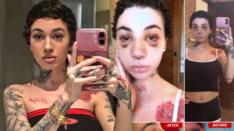 Bhad Bhabie Shows Off Nose Job, Reveals Type of Cancer She Has
