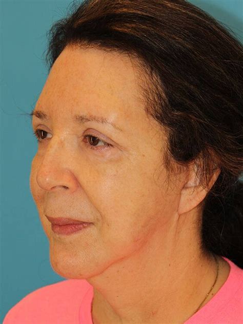Before & After Face & Neck Lift Bellaire | Face Forward