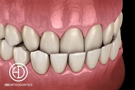 What is the best way to correct an underbite? Aswers Long Beach ...