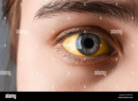 Woman with yellow eyes on grey background, closeup. Symptom of ...