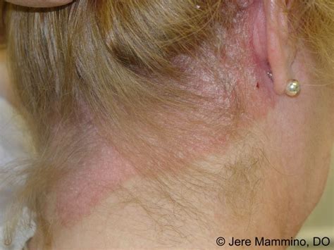psoriazis in cap | nandcingaca1970's Ownd
