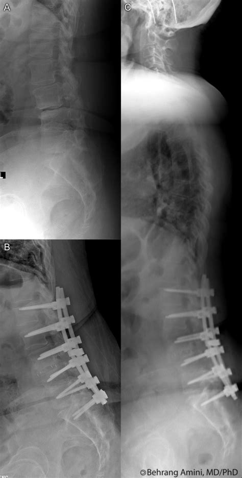 roentgen ray reader sagittal balance   flat  syndrome