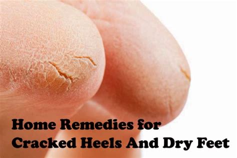 Home Remedy Very Dry Cracked Feet load - gratishaven