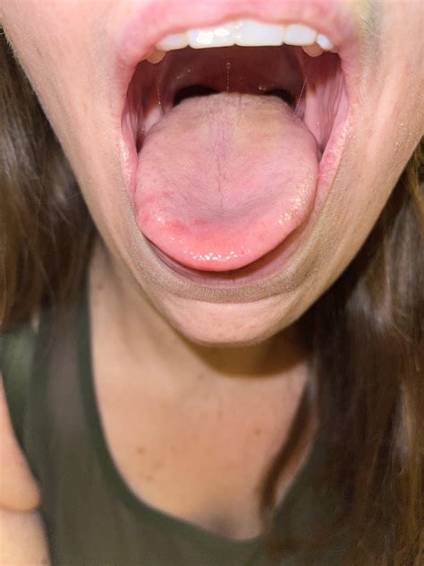 My tongue hurts/burns. Has these red spots on it. What helps you? Do I