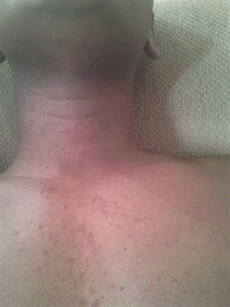 That-Rash: Pityrosporum Folliculitis or Keto Rash or Whatever That Rash