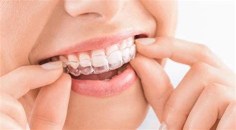 Invisalign Clinic Kadavanthra - Dental Clear Aligners - Dental Point