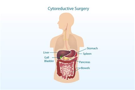 Cytoreductive Surgery (CRS) - Apollo CBCC Cancer Care