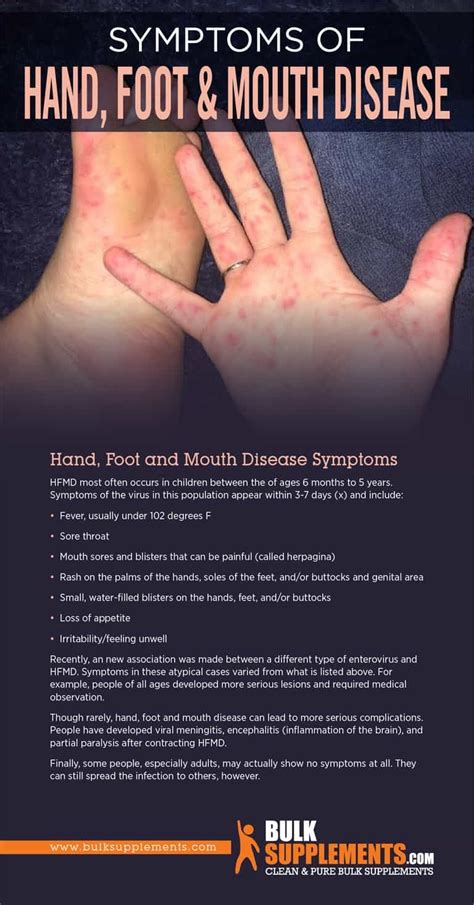 Hand, Foot, and Mouth Disease (HFMD): Symptoms, Causes & Treatment