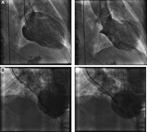 Rare recurrence of apical ballooning (takotsubo) syndrome in an elderly