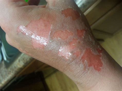 Second-Degree Burns: Pictures, Treatment, Healing Stages