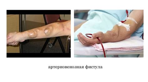 Хронический гемодиализ - презентация онлайн