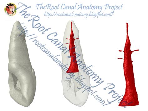 The Root Canal Anatomy Project: Two-Rooted Maxillary Central Incisor