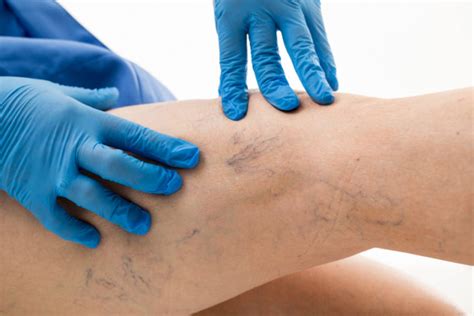 Skleroterapia zamykanie naczyń krwionośnych, zabieg wykonuje lekarz