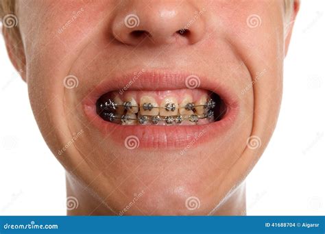 braces set  teeth  laci briggs blog