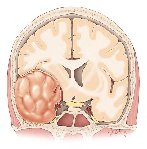 epidemiology  etiology  meningioma xhza