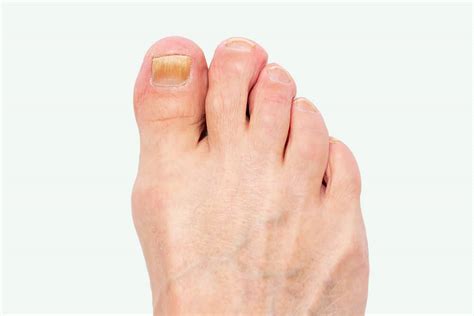 Fungal nail infection (onychomycosis) | Diagnosis, Causes & Treatments