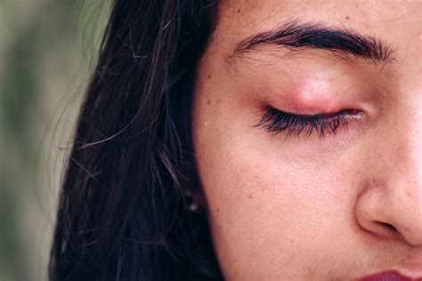 staph infection  symptoms diagnosis treatment theanswerguide