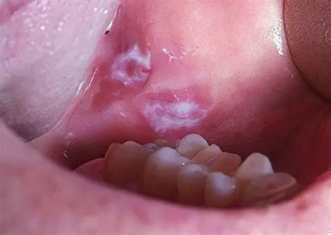 oral leukoplakia symptoms  treatment healthy food