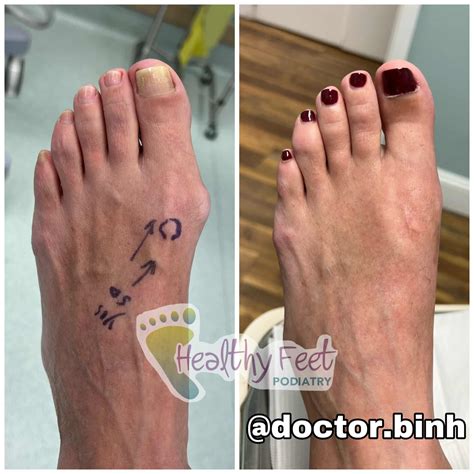 Minimally Invasive Bunion Surgery Wesley Chapel FL