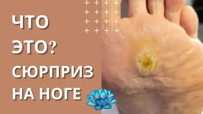 Шипица на ноге (60 картинок)