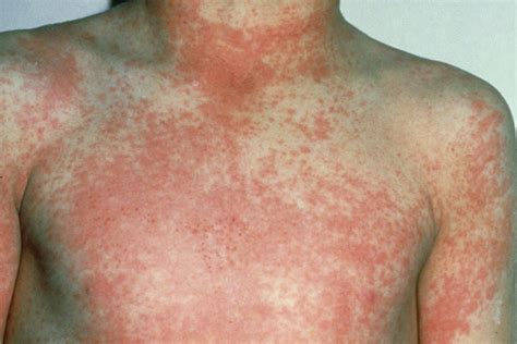Scarlet Fever - Cyprus Dermatology Clinic