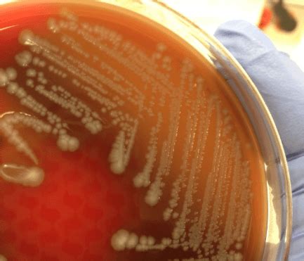 Bacteria E Coli Urina - E. Coli No Resultado Do Exame De Cultura De Urina E Outras Bactérias Em ...
