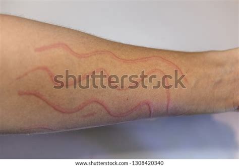 Dermatographic Urticaria Known Dermographism Dermatographism Skin Stock ...