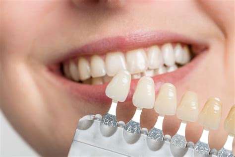 Veneers Dartford - Veneer Teeth - Cosmetic Dentist Crayford