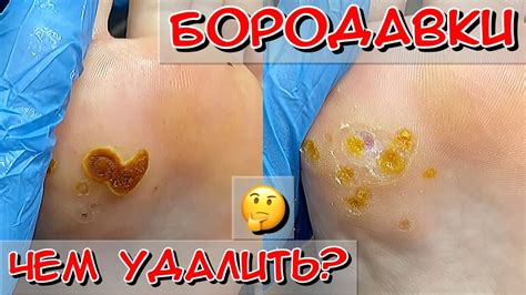 Чем удалять бородавки? / бородавки на стопе / заключительный визит ...