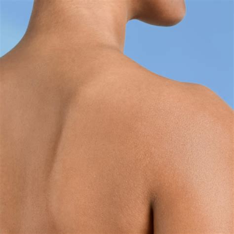 All about ichthyosis: causes, symptoms and treatments