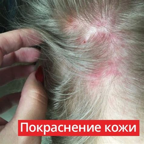 Покраснение кожи головы... почему появляется? Если пациента беспокоят ...