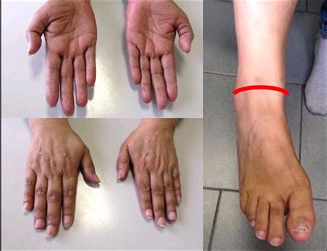 Melanosis of hands and feet: The dark coloration of the skin does not ...