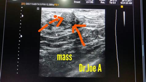 Ultrasound imaging: Breast fibroadenoma